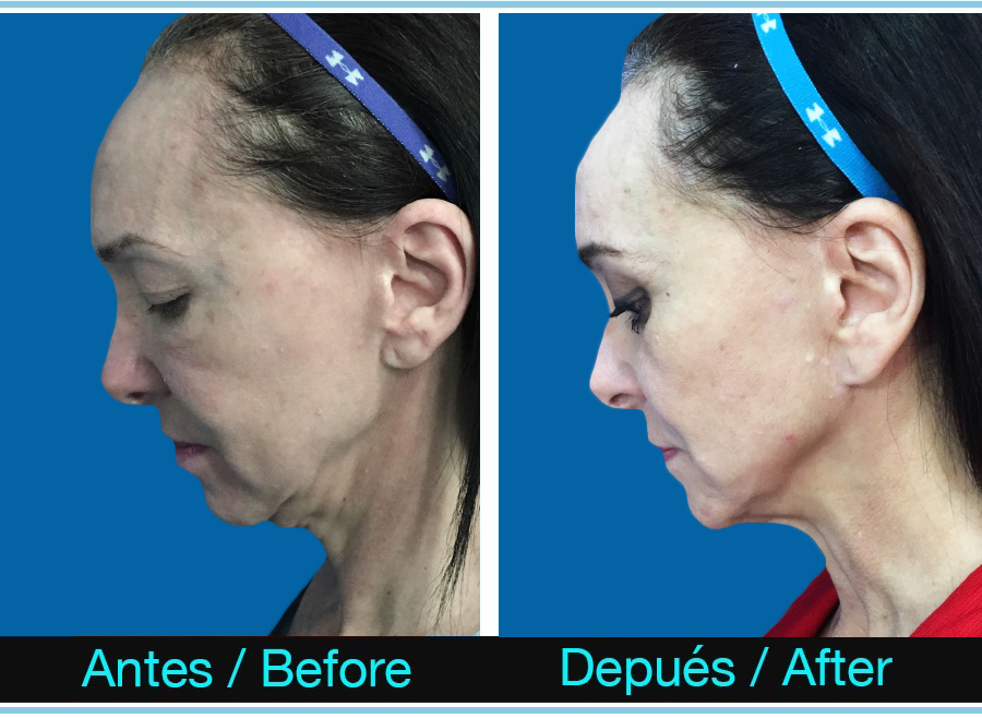 Radiofrecuencia Cuello Antes Y Después ️ Rejuvenece tu mirada con blefaroplastia en Madrid | Dr. Colombo