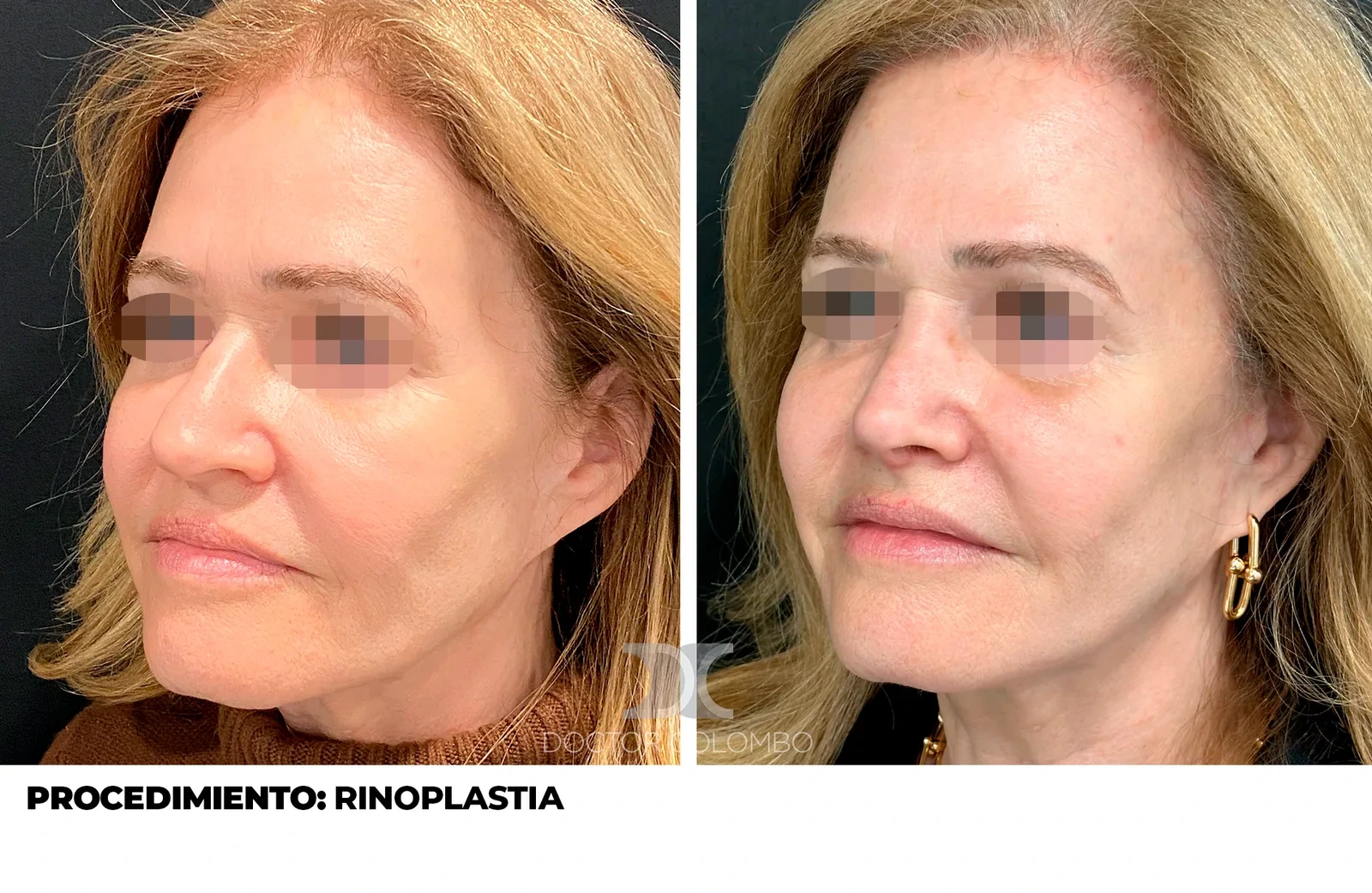 Resultado de gibectomía - antes y después de perfil